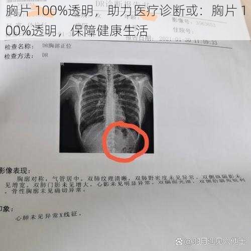 胸片 100%透明，助力医疗诊断或：胸片 100%透明，保障健康生活